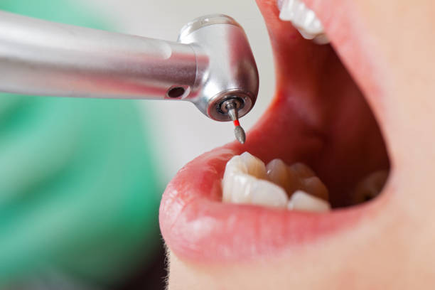 Best Knocked-Out Tooth (Avulsed Tooth) Treatment in Duchesne, UT